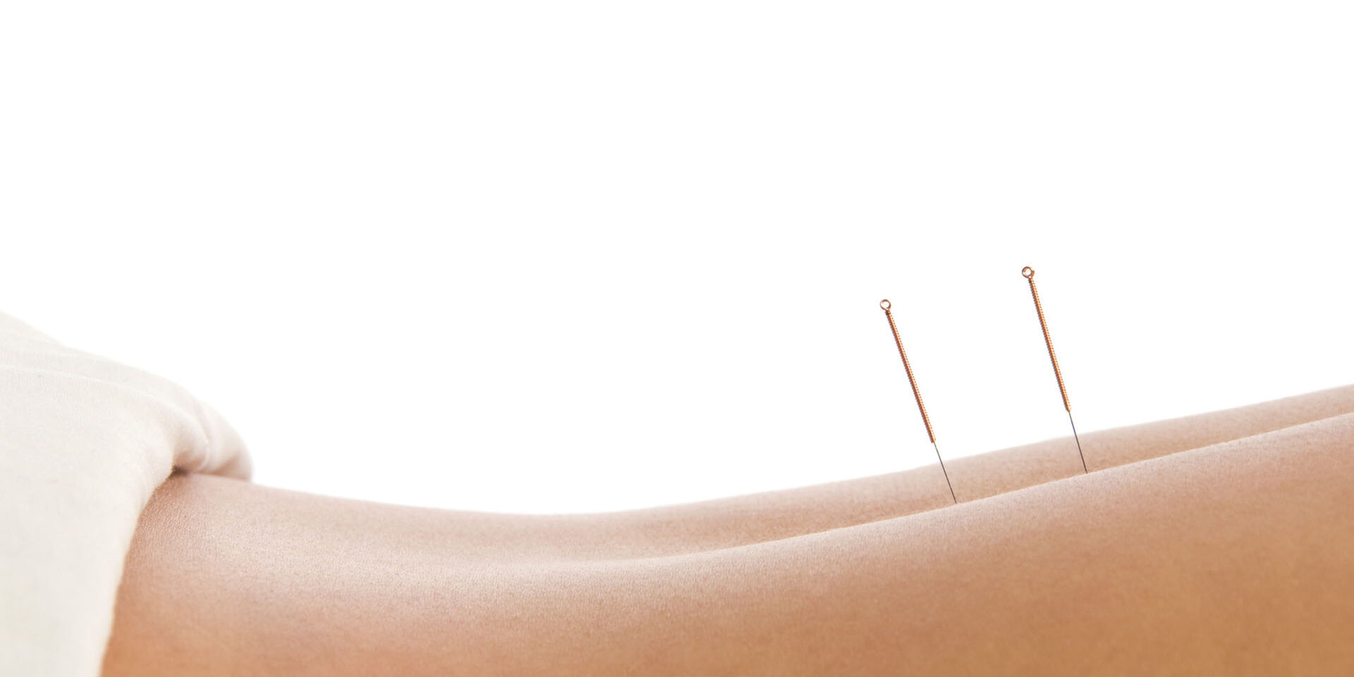 Acupuncture Woman getting an acupuncture treatment in a spa